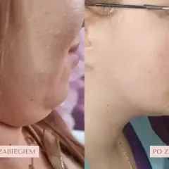Przed i po zabiegu lipolizy iniekcyjnej. Widoczna redukcja podwójnego podbródka, poprawa linii żuchwy.