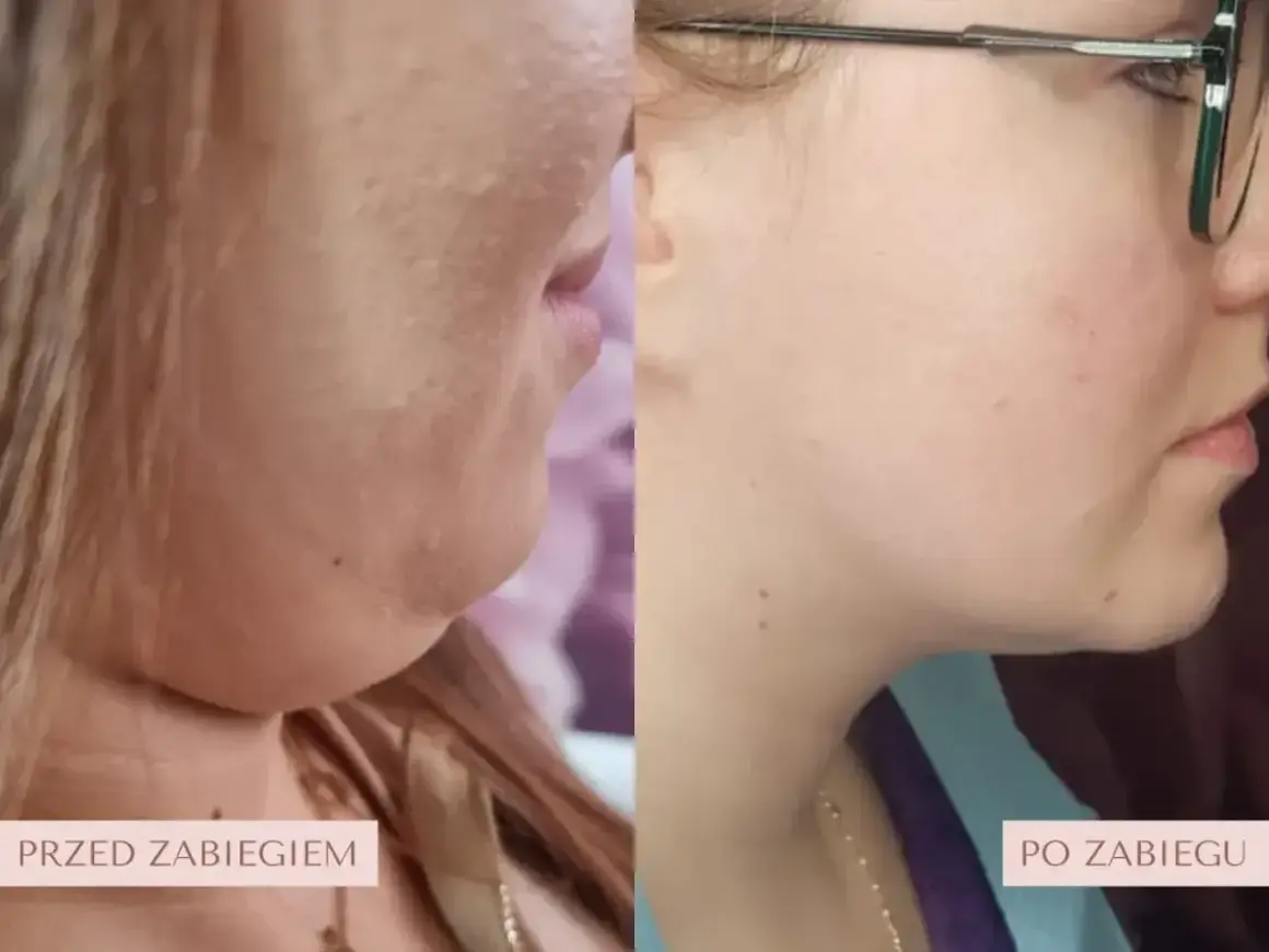 Przed i po zabiegu lipolizy iniekcyjnej. Widoczna redukcja podwójnego podbródka, poprawa linii żuchwy.